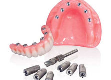 removable-implants-dentures-222x160